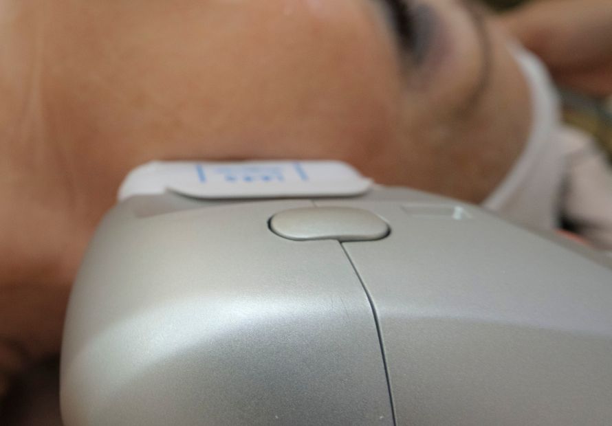 Hifu facial. Última tecnología para el rejuvenecimiento facial