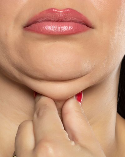 elimina-la-papada-sin-cirugia-con-hifu-7d