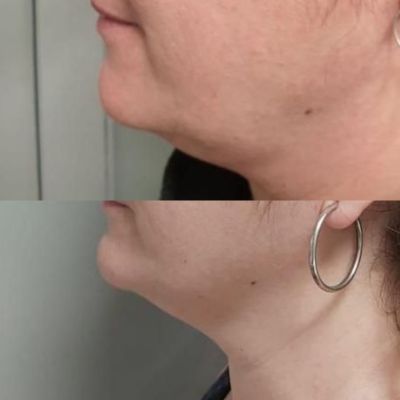 hifu-papada-antes-y-despues