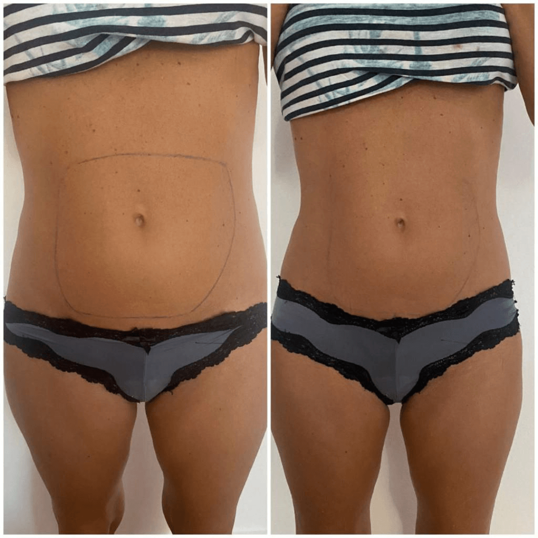 antes-y-despues-liposonix-abdomen-1