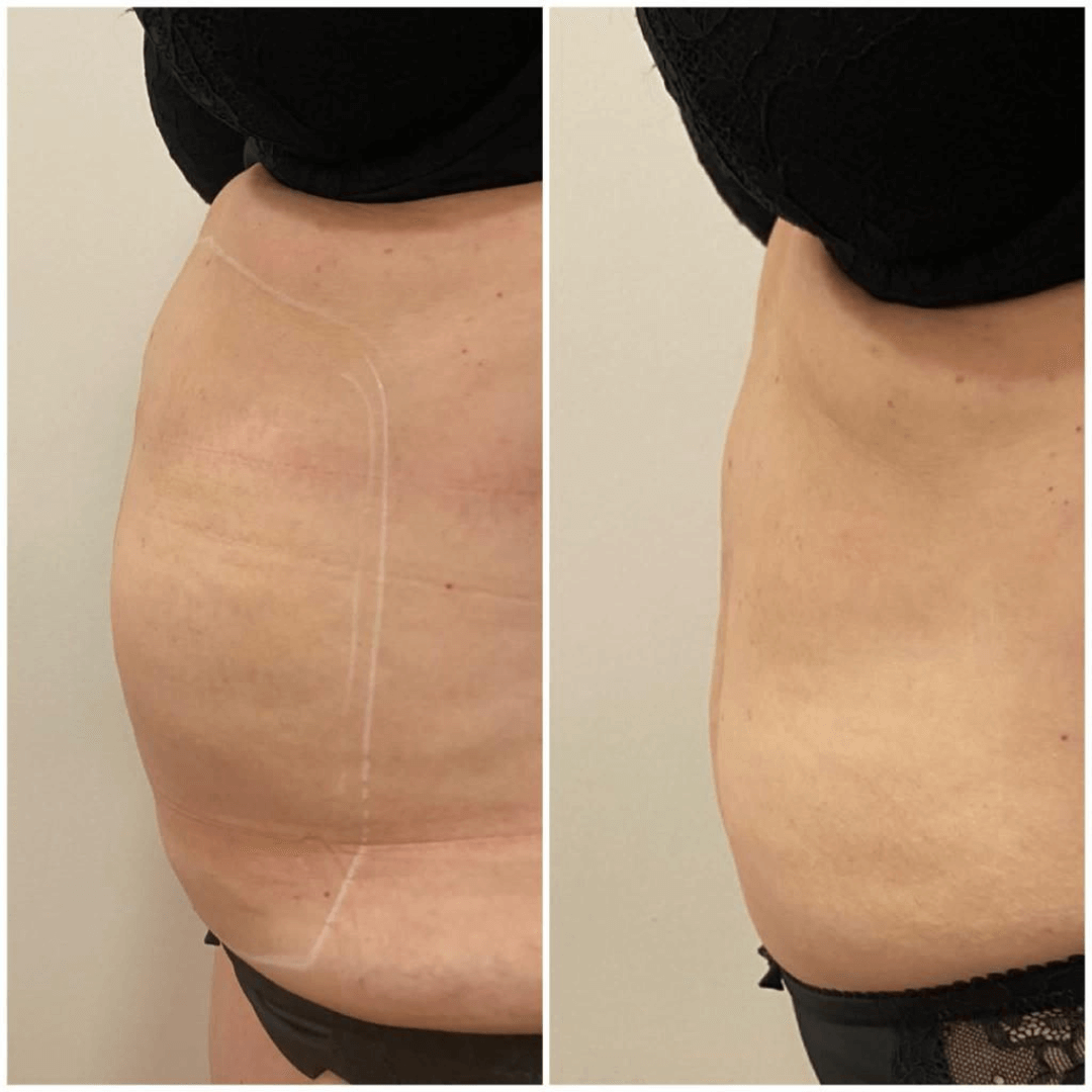 antes-y-despues-liposonix-abdomen-2
