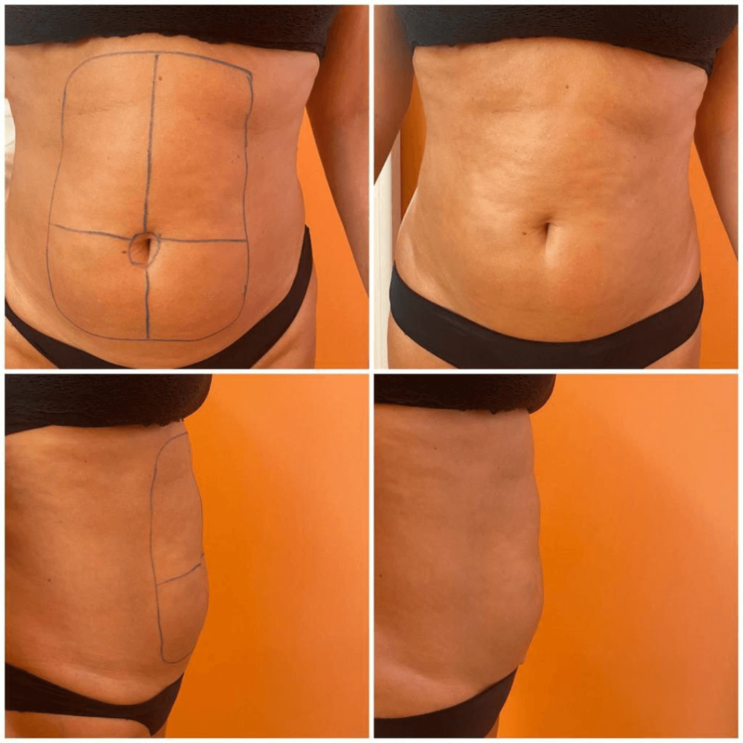 antes-y-despues-liposonix