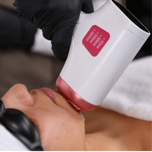 zonas-a-tratar-laser-4d-facial