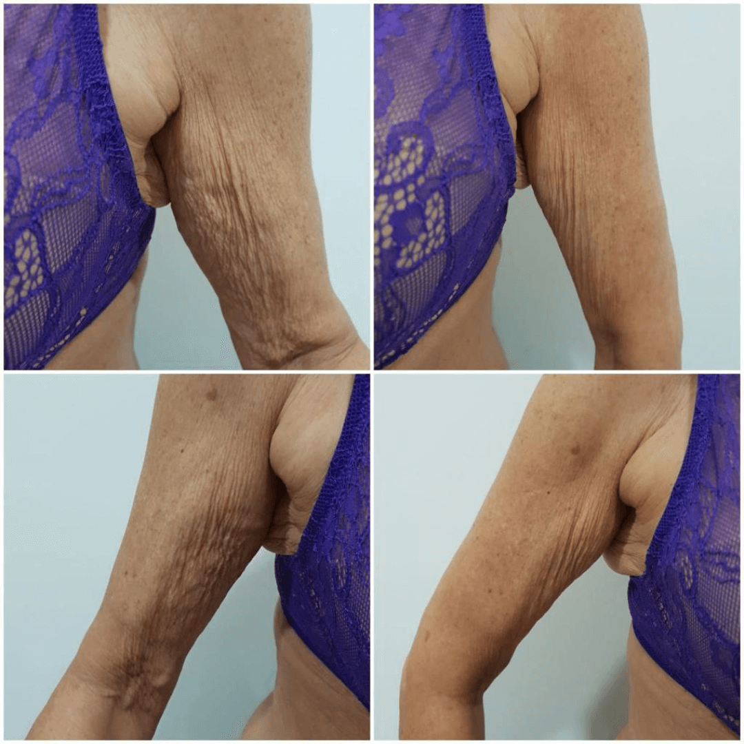 antes-y-despues-hifu-7d-brazo