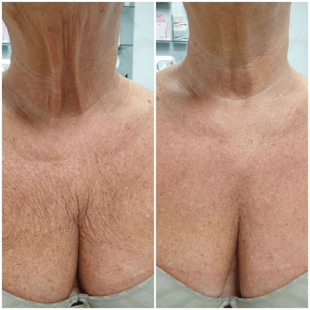 antes-y-despues-hifu-7d-escote