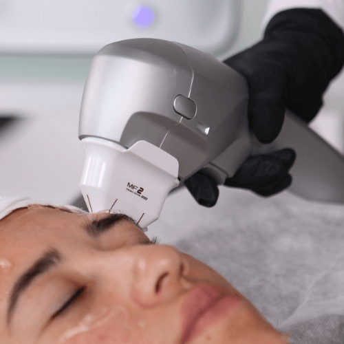 zonas-a-tratar-hifu-7d-facial