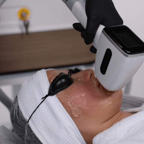 zonas-a tratar-laser-chip-facial