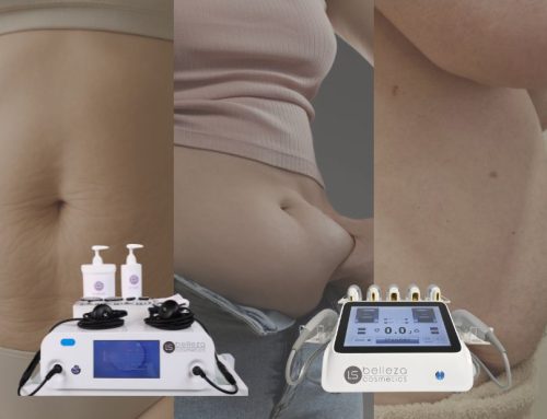 Flacidez abdominal sin cirugía ¿Qué funciona de verdad?