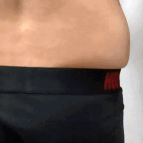 Antes de la criolipolisis Antes de la criolipolisis